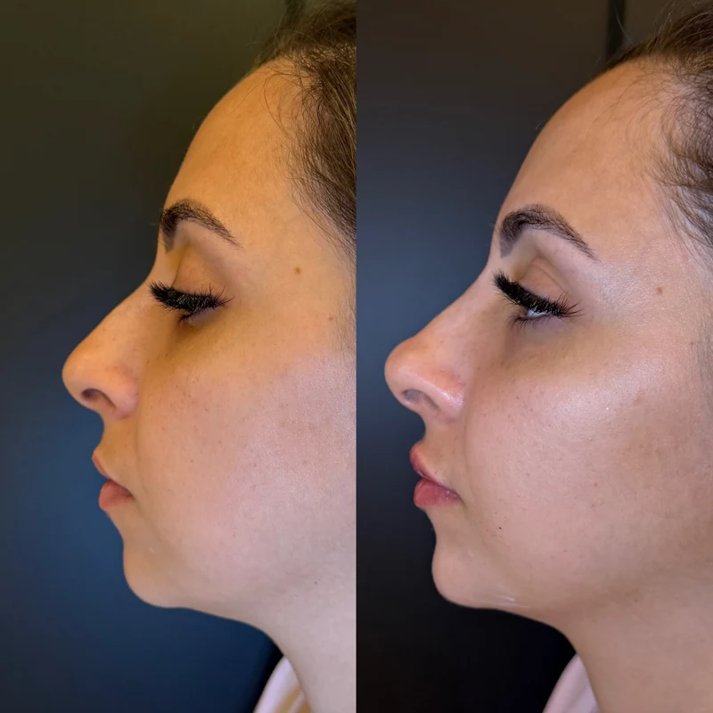 Comparação real de perfil mostrando os contornos do rosto