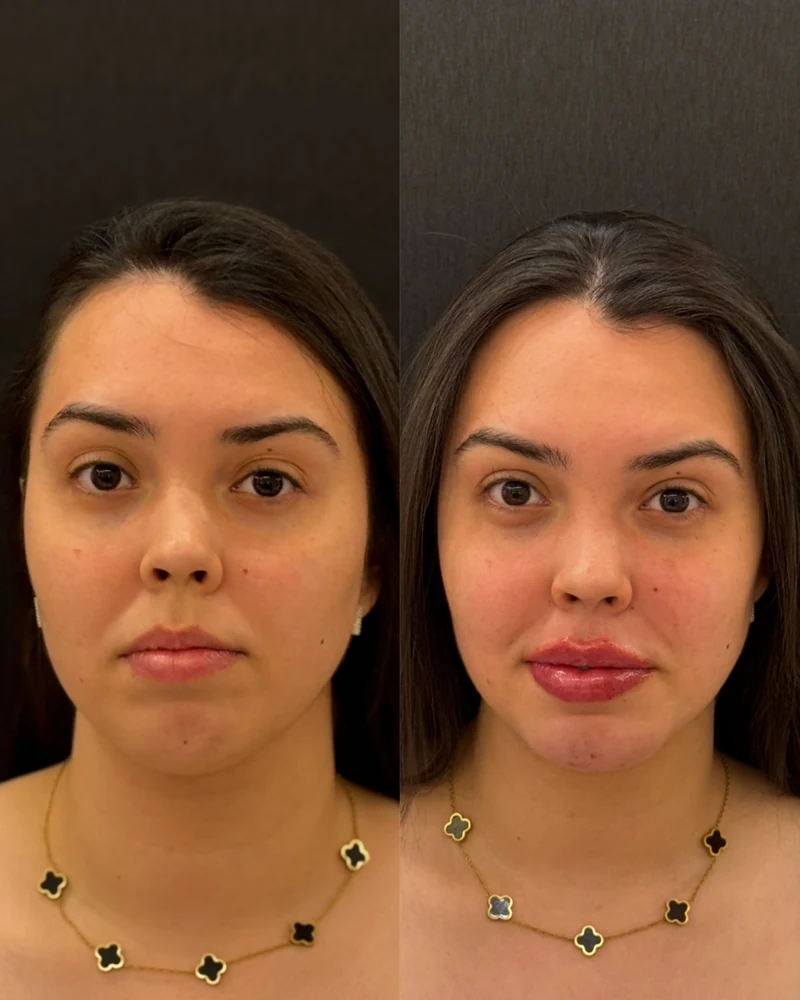 Registro real frontal lado a lado, antes e depois de um cuidado facial