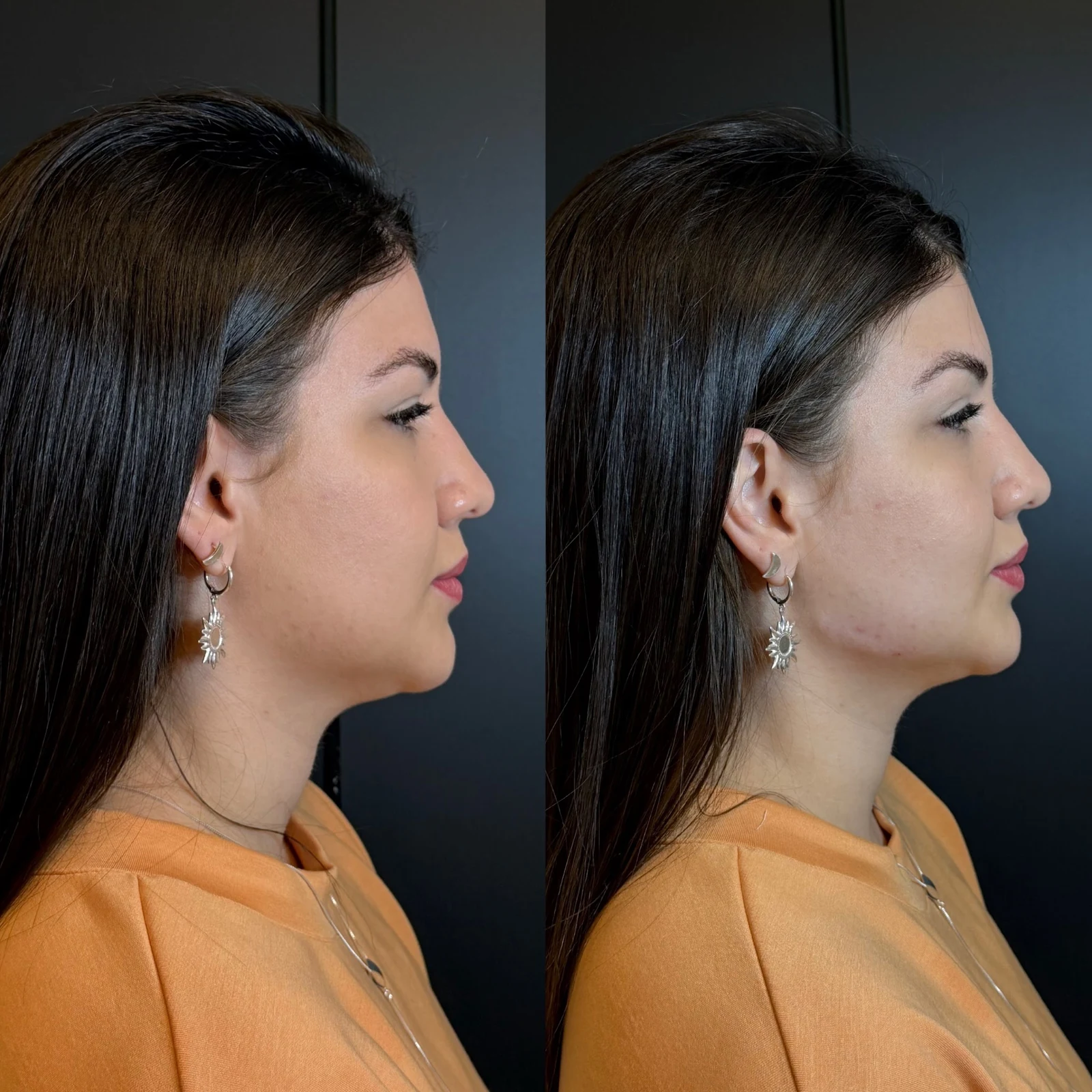 Perfil facial antes do cuidado, em registro fornecido pela Dra. Camila Castro